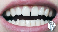 Diastema