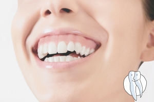 Gummy Smile