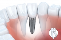 Diagnose-Kaugummi bei Implantaten?